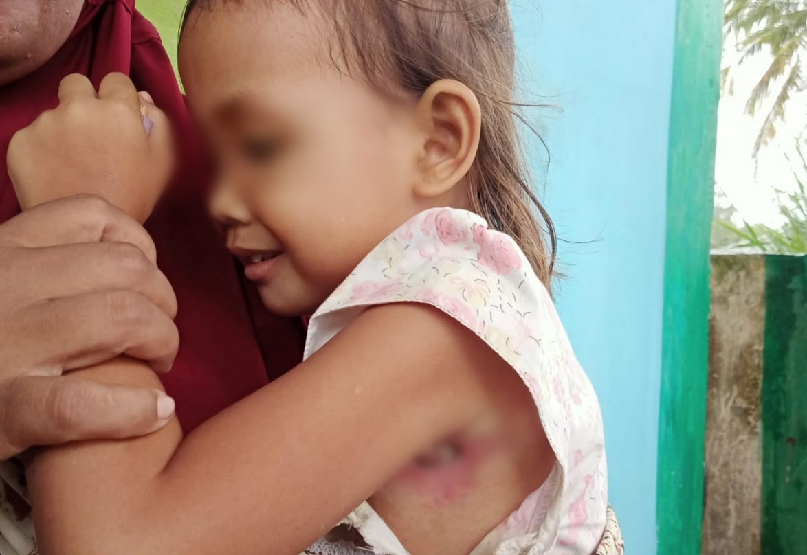 Tak Punya Biaya Berobat, Ketiak Balita di Sidimpuan Bolong Akibat Infeksi
